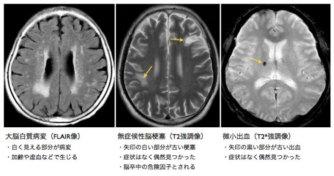 脳MRI 1 正常解剖 【75%OFF!】
